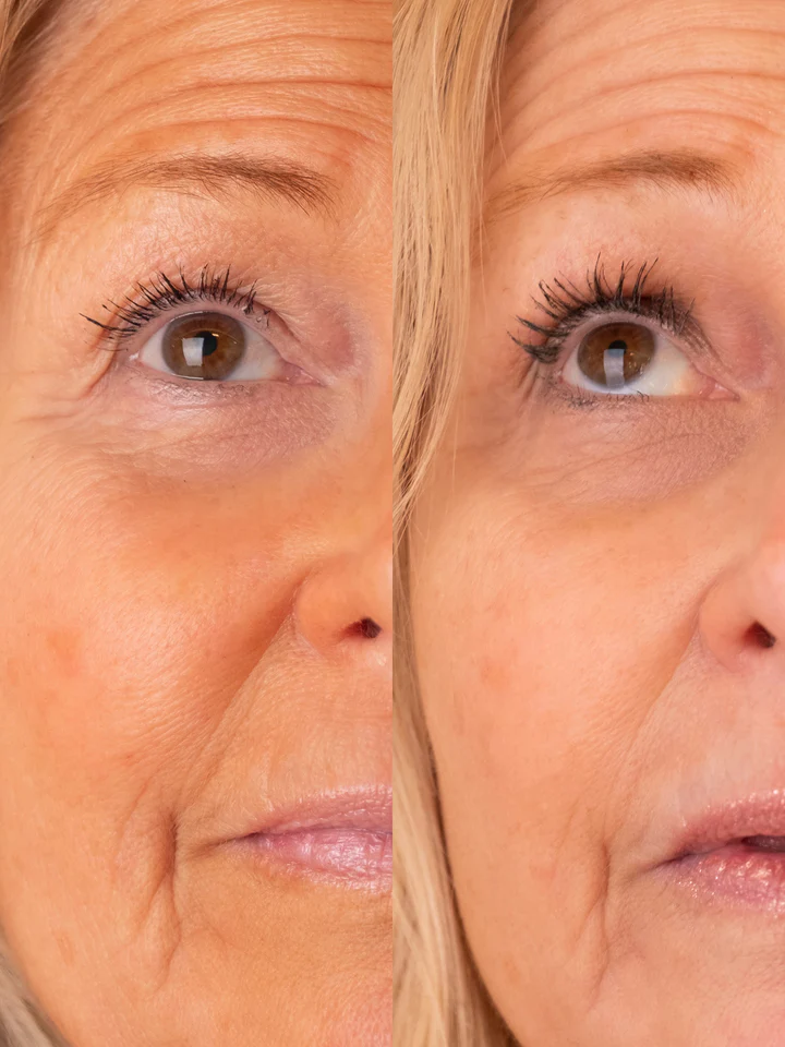 Before and after results